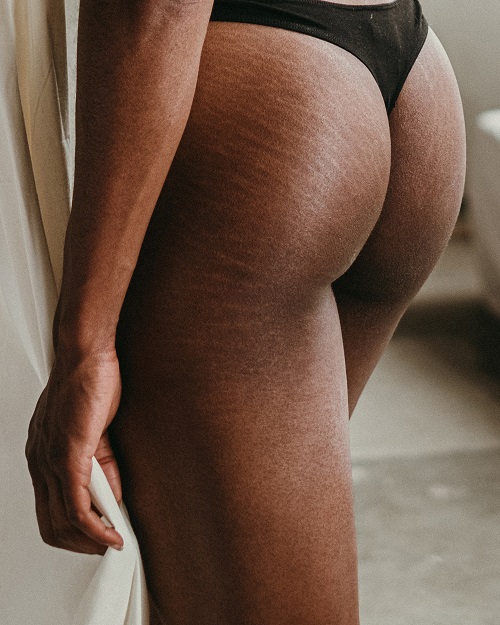 Weight Loss Stretch Marks